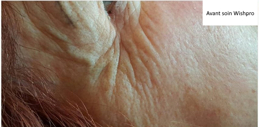 Résultat soin visage Wishpro – avant/après effet repulpant à Argelès-sur-Mer